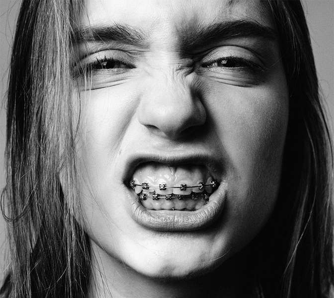 tudo-sobre-aparelho-para-os-dentes Aparelho pode corrigir outros problemas além da estética? Confira as 7 perguntas e respostas