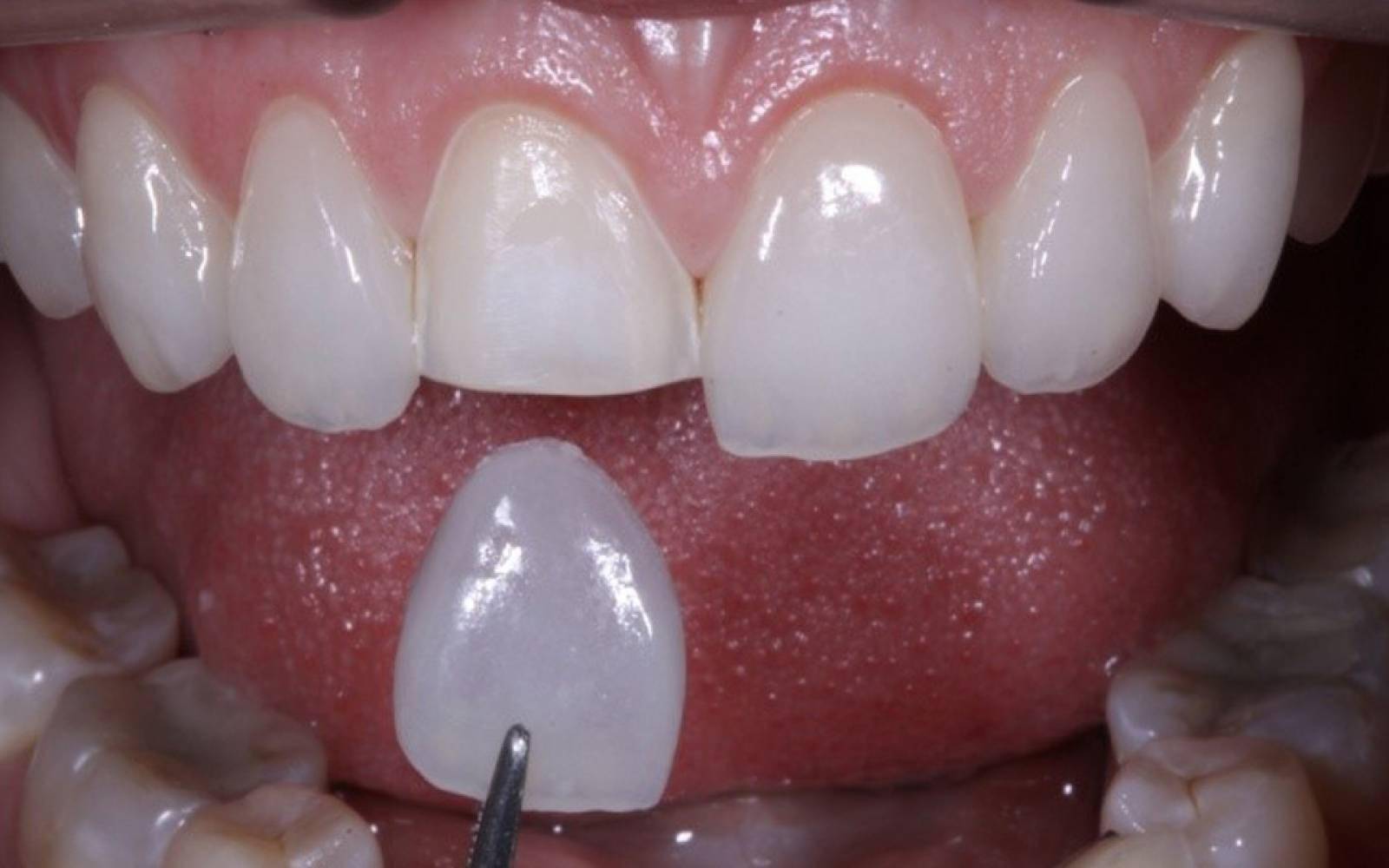 É o dentista quem vai decidir se será necessário ou não o desgaste dos dentes para colocar as facetas dentárias em Goiânia | Foto: Reprodução