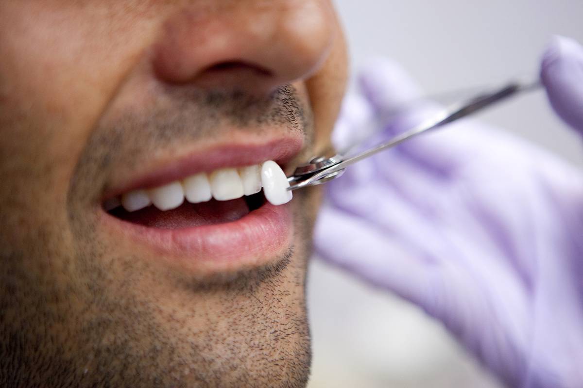 facetas dentárias em Goiânia podem ser de porcelana ou resina | Foto: Reprodução