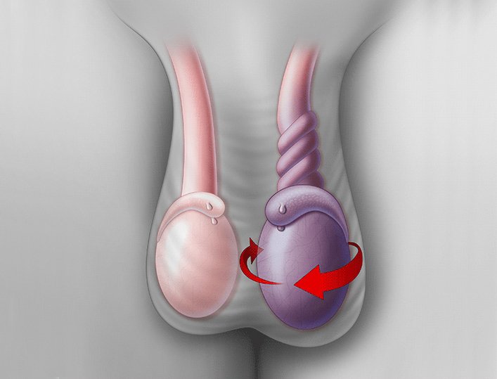 Torção testicular é causada quando há um desenvolvimento anômalo do cordão espermático ou da membrana que envolve o testículo | Foto: Ilustrativa
