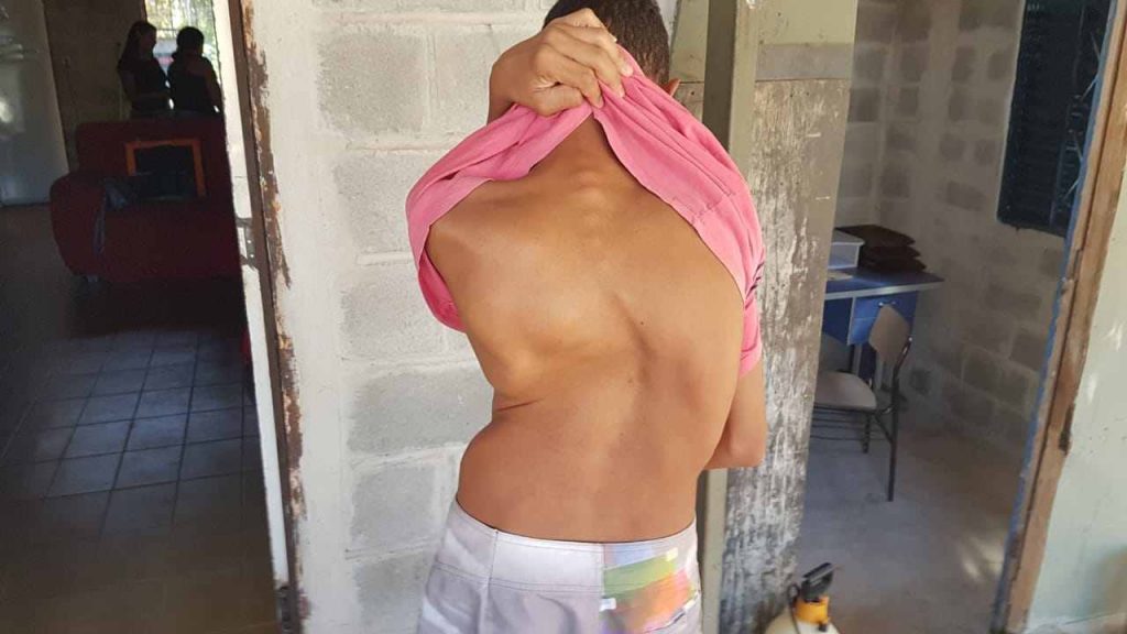 Gabriel de Almeida, 18, enfrenta escoliose, grave distorção na coluna, há 7 anos enquanto o SUS posterga sua cirurgia | Foto: Folha Z Gabriel de Almeida, 18, enfrenta escoliose, grave distorção na coluna, há 7 anos enquanto o SUS posterga sua cirurgia | Foto: Folha Z