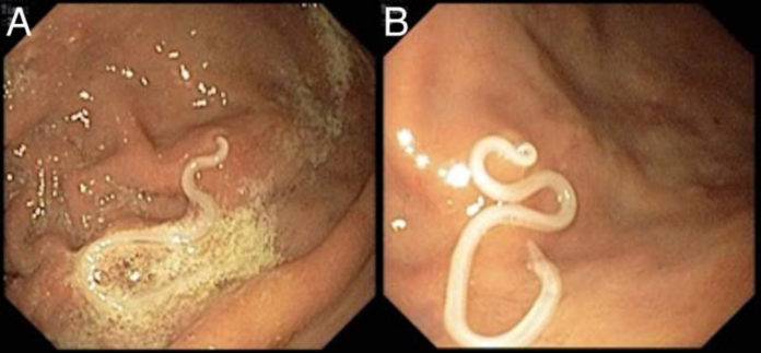 Endoscopias de paciente que após consumir sushi, desenvolveu parasita que ficou firmemente preso a uma área da mucosa intestinal, causando inchaço e hiperemia. Para retirar foi necessário de procedimento cirúrgico | Foto: Carmo J, Marques S, Bispo M, et al. BMJ Case Rep Published
