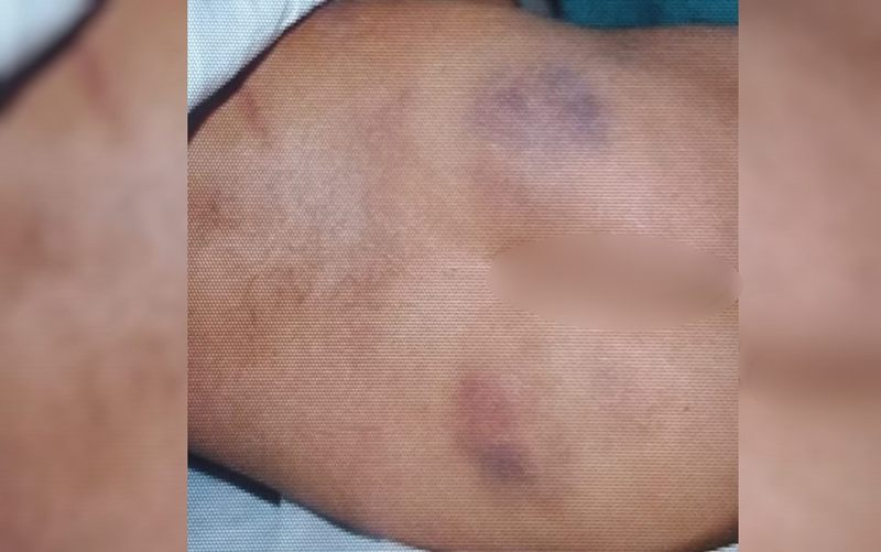 Laudo do IML aponta hematomas nas costas e nas pernas da criança | Foto: Divulgação