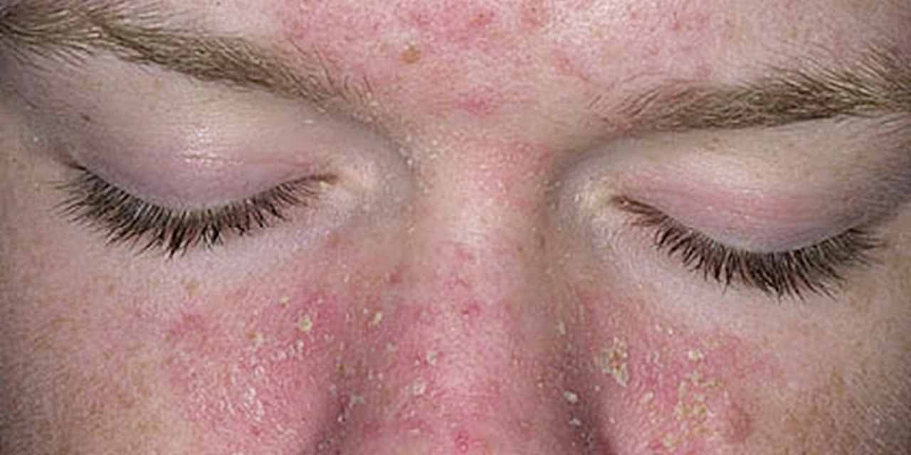 dermatite seborreica doença