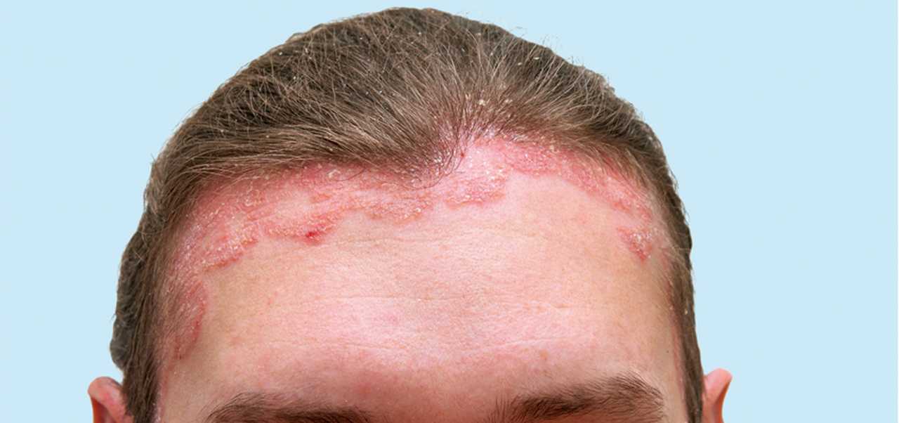 dermatite seborreica saiba mais