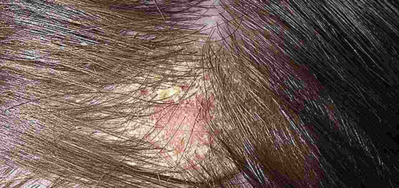 doença dermatite seborreica
