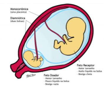 síndrome transfusão feto-fetal Aparecida